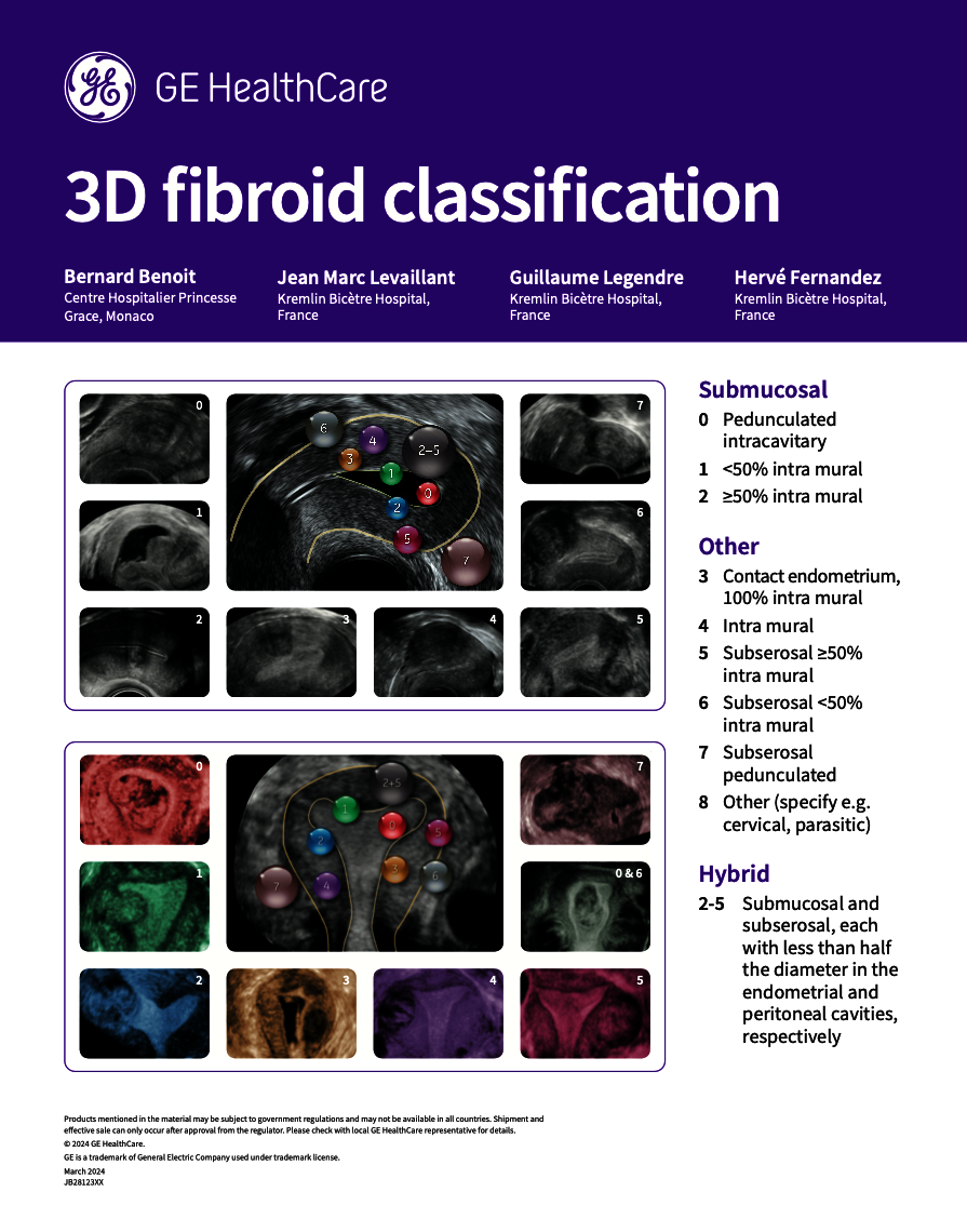  3D Fibroid Classification