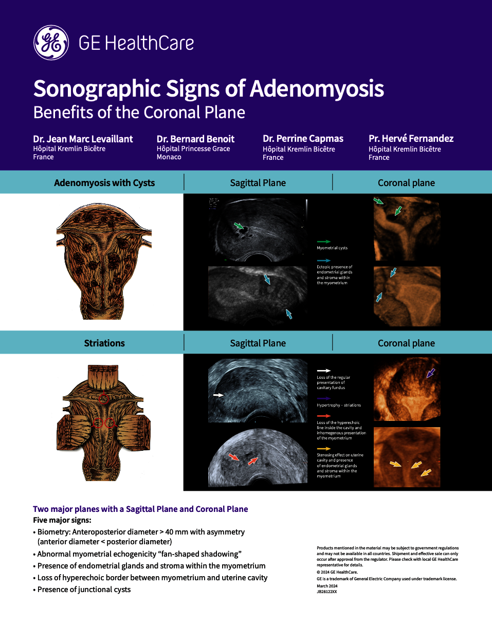  Sonographic signs of Adenomyosis