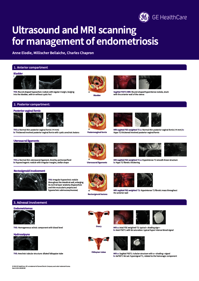  Ultrasound and MRI scanning for management of endometriosis