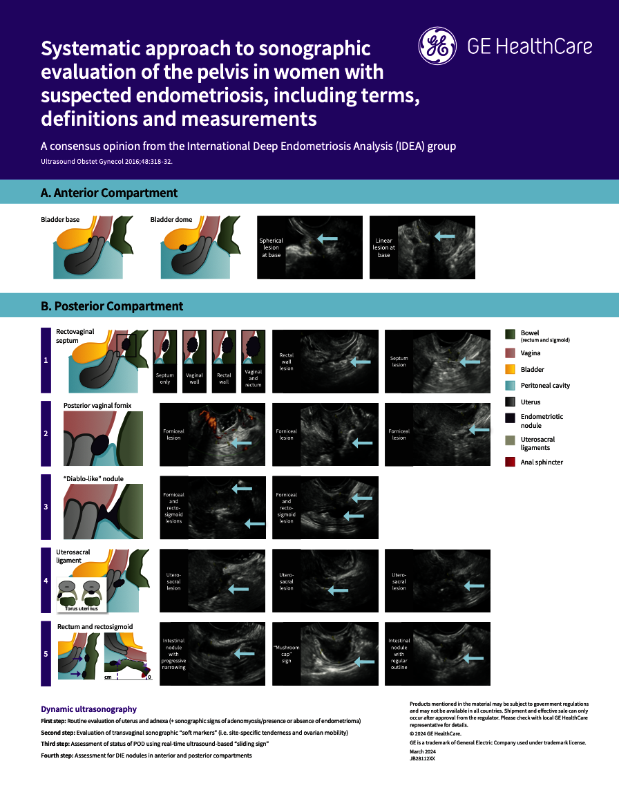  Ultrasound in Endometriosis (IDEA Consensus)