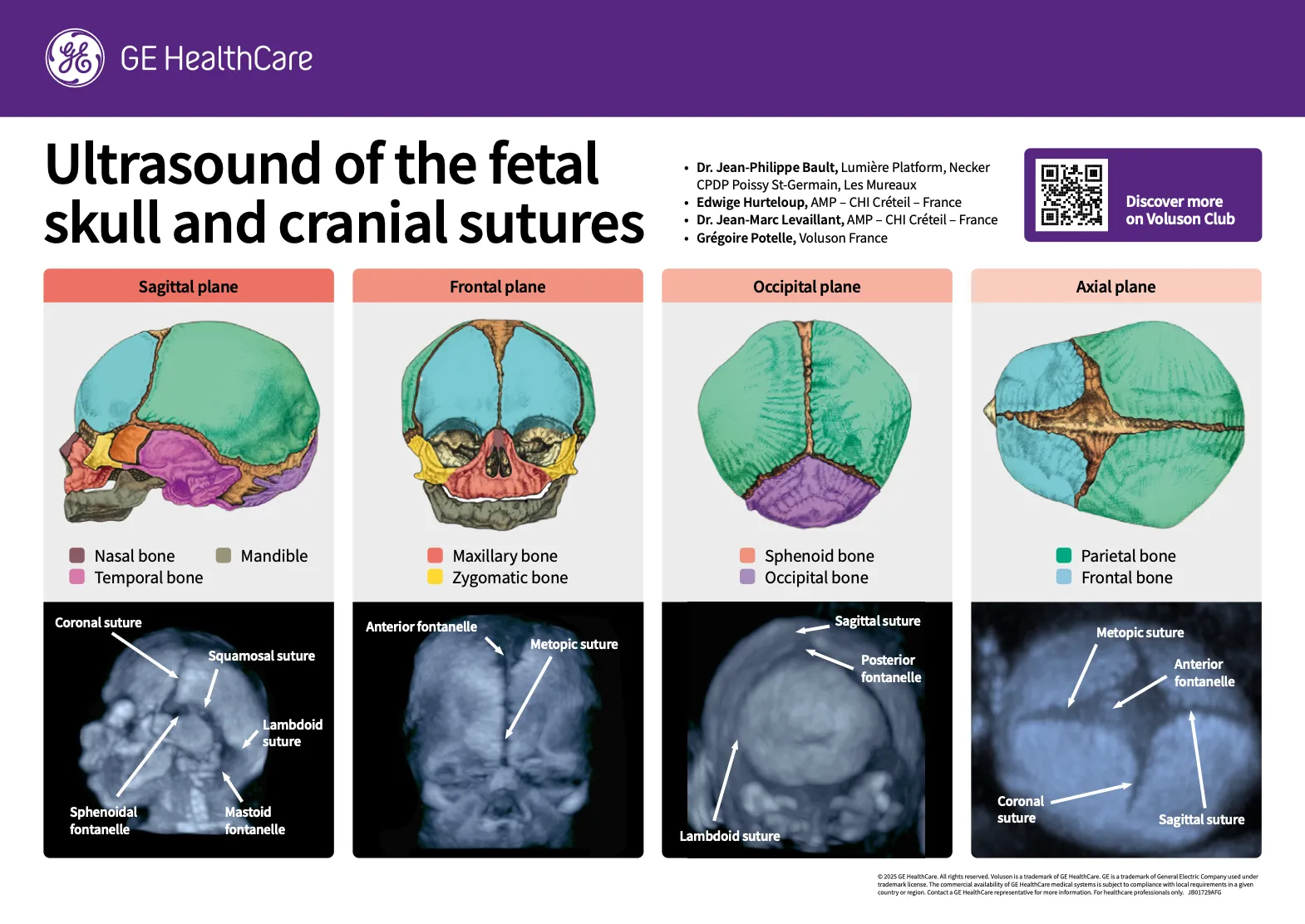  Ultrasound of the fetal skull and cranial sutures