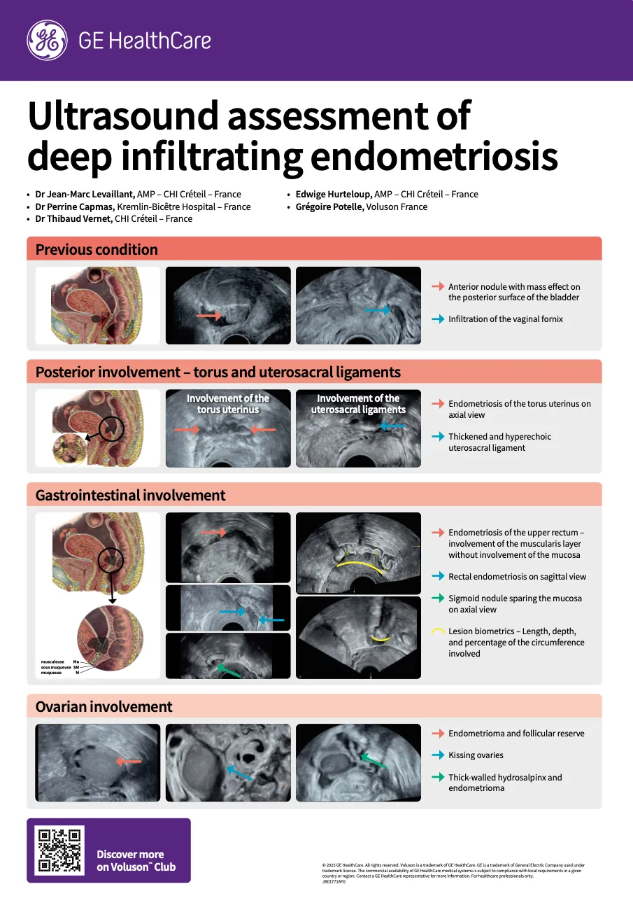  Ultrasound assessment of deep infiltrating endometriosis