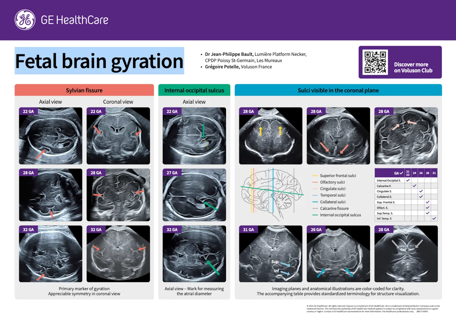  Fetal brain gyration