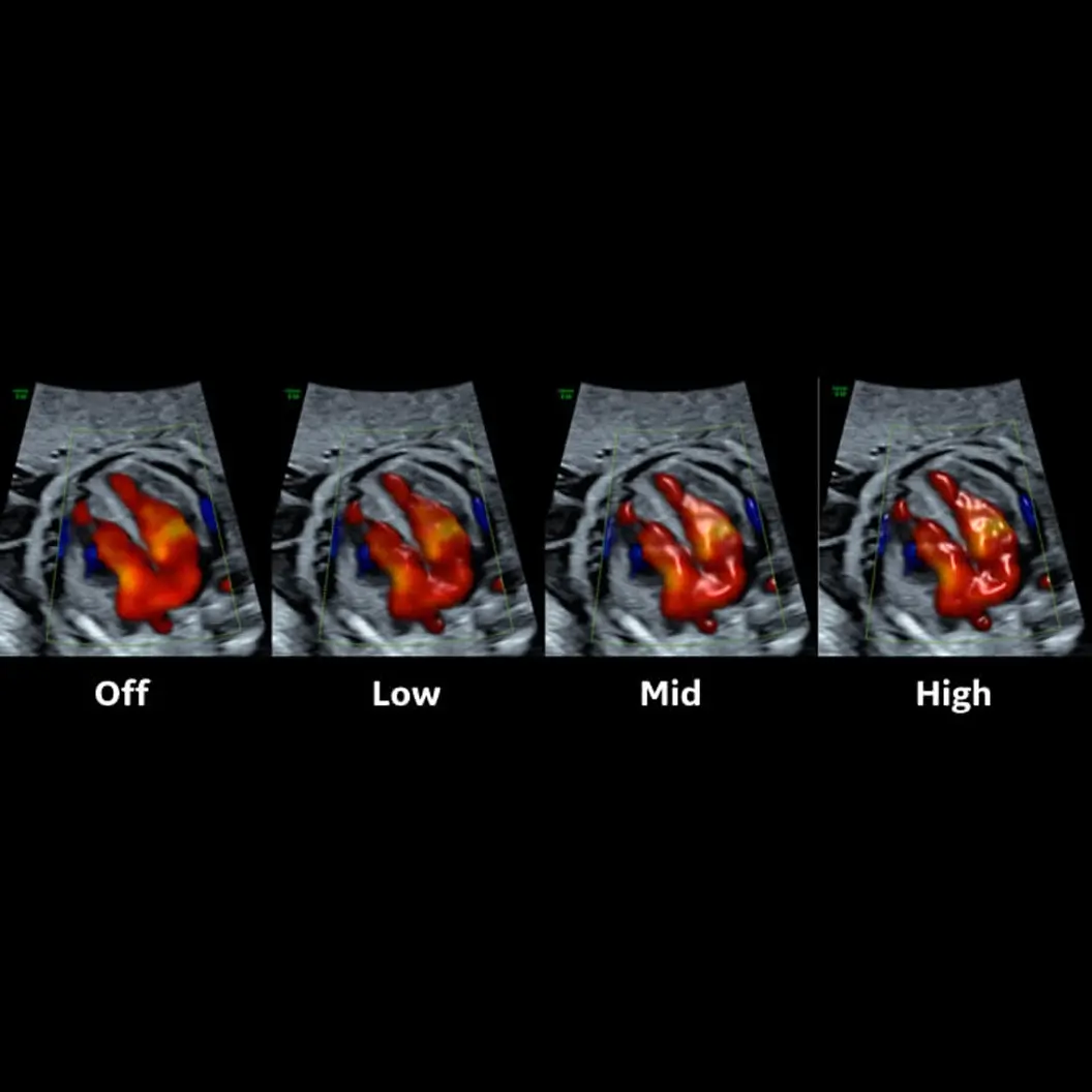 Imaging ad ultrasuoni di Voluson