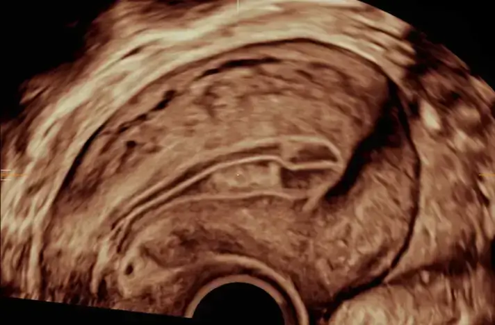 Uterine assessment images 2